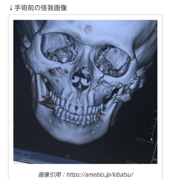 顔面殴られ重傷負った椿隆之、加害者の開き直った態度に本音「呆れるとしか言いようがない」：コメント9