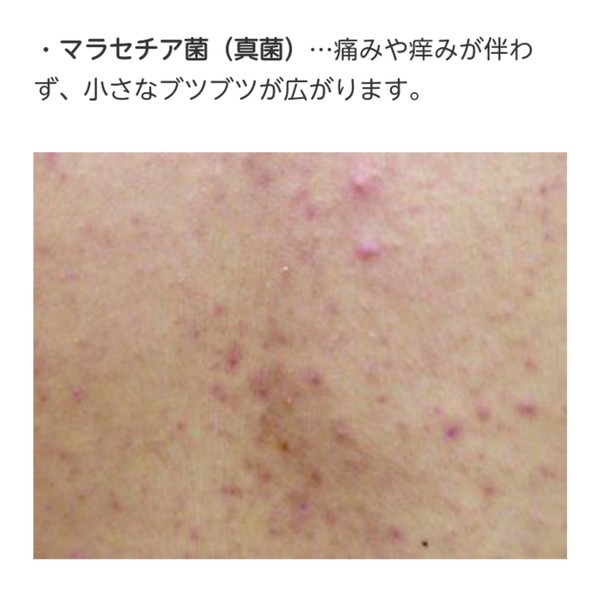 蛭子能収 背中にカビ「マセラチア菌」が繁殖 加齢臭原因に:コメント19