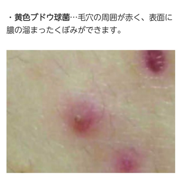 蛭子能収 背中にカビ「マセラチア菌」が繁殖 加齢臭原因に:コメント20