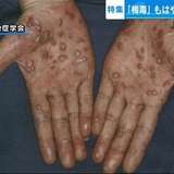 「梅毒」が急増　“誰もがかかりうる病気”に…症状がすぐに消えるため「治った」と勘違いして悪化も